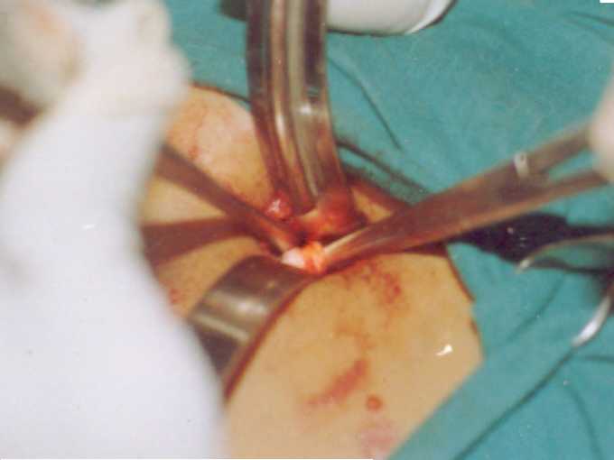 Gall Bladder Incision Showing Cystic Duct